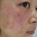 기미 잡티 주근깨 색소침착레이저 내돈내산 (+가격) 1회로 효과본 후기