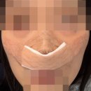 성은병원 | 콧볼축소술 내돈내산 후기 1 | 수술계기, 발품과정