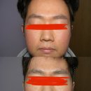 동일한의원 | 바른샘 한의원 방문기: 지루성 피부염 한의원 치료 후기 4편 🌿 최종 후기