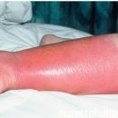 봉와직염(Cellulitis) 이미지