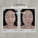 [고양 원흥 윤곽관리] 에스테티아 고양원흥역점에서 직접 받아본 후기 – 얼굴 라인 대박 변화