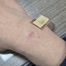 신양화학약품(주) | 화상전문병원 : 동탄 화외과의원 화학화상 치료 후기