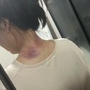 때빼멍 | 내돈내산)페이스튠핏 아주만족/바디컷튠핏V2 실사용후기 그리고 멍(추추가후기)