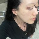 삼아제약(주) | 유치원때부터 갖고 있었던 주근깨 굿바이 하는 날/ 루비레이저 생생 후기! / 내돈내산 / 압구정 루비레이저