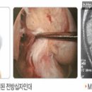 [십자인대파열] 십자인대파열 가장 부상 많이 일어나는 부위. 이미지