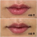 부산입술필러 서면에서 자연스럽게 시술 잘하는곳 찾음! 내돈내산 후기
