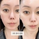예쁘다 개 | 의정부 피부관리 예쁘다에스테틱 탄력리프팅 전후 비교 후기, 1회 관리 변화