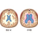 ﻿수두증 (Hydrocephalus) = 뇌수종 이미지