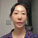 피부과이야기#3| 40대 탄력리프팅 ,에프터케어,티타늄리프팅 후기 ,에스테필,보톡스