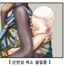 선천성 색소결핍증[Congenital Albinism]피부질환 이미지