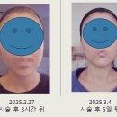 온다 리프팅(Onda Lifting), 실제 효과는? 시술 후기와 장점 총정리