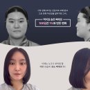 일퍼센트성형외과의원 | ‘슬픈삐에로’의 용기 있는 도전, 일퍼센트성형외과와 함께한 맥미걸 코성형 등 복합 솔루션✨