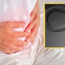 “무농약이라 그냥 먹었는데”… 60세男 장에서 피 빨던 갈고리충 4마리 이미지