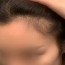 세정약국 | 약국 탈모약 판시딜 남자 여자 복용 후기 용량 탈모완화 효과 부작용