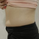 S fit(에스핏) | 복부비만주사 후기 배둘레 줄이는 법