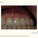 병점뉴욕치과의원 | 병점 치과 추천 , 임플란트 주위염 '3가지' 치료 방법