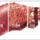 (알콜중독치료) 알콜성 간질환과 예방법 이미지