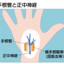 갱년기 여성에게 많은 수근관 증후군. 고령에서 발병은 심부전과의 관련성도 부상. 이미지