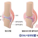 무릎통증러들의 딜레마 이미지