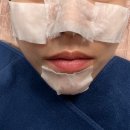 브이 | 기미·홍조·잡티 피부 고민별 색소레이저, 엑셀브이후기와 시술 경험 공유