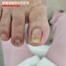 비나이더 주엽점 | 내성발톱 골프치고 심한 통증발톱 좋아진 레푸스일산주엽점 후기[골프/골프화/일산발톱관리/파고드는발톱]