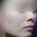 (주)리체 | 마포 여드름치료 내돈내산 정착기 (3번 실패 극복 솔직 후기)