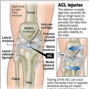 전방십자인대 수술후 재활운동중 근력평가하기 [영상첨부] 이미지