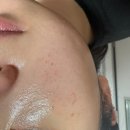 김포 편평사마귀 제거하러갈 때 &#39;이거&#39; 체크하는거 잊지않으셨죠? 편평제거후기 보세요.