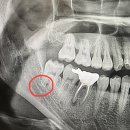 광교신경과의원 | 광교 사랑니 발치 치과 추천, 사랑니 발치 후기(매복 사랑니, 내돈내산)