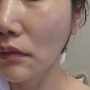 하얀멍이 | 부산 서면 피부과 쥬베룩 아이 눈밑꺼짐 후기 쥬베룩아이 붓기 일상생활