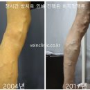 하지정맥류, 꼭 치료해야 할까요? 이미지