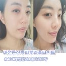 40 | 대전 둔산동 피부과 40대 추천 올타이트리프팅 후기(가격, 효과)
