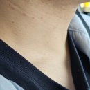 백만목욕탕 | 수원편평사마귀 제거 무제한 레이저로 목 전체 싸악 지운 후기