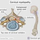 문성보조기 | “경추 척수증 수술 전에 꼭 알아야 할 사실”