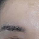 미간주름 거의 폈어요~ (미간주름없애는방법, 미간주름필러, 미간주름패치, 미간보톡스부작용) 이미지