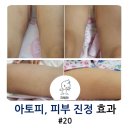울배 | [후기 #20] 아토피 진정 효과