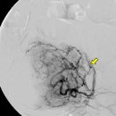 자궁근종 색전술[embolization of uterine myoma] 이미지
