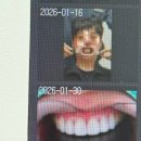 제로치과병원 | 제로라미네이트 무삭제라미네이트 퍼스널라미제로 후기(100% 내돈내산)