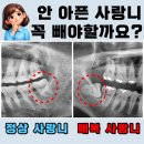 줄포S치과의원 | 안 아픈 사랑니, 그냥 두면 생기는 일 (수유역 매복사랑니 실제 사례)