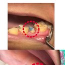 연세우리집치과의원 | [아산 연세원치과]신경치료 재료 '가타퍼차', 내 치아 속을 메우는 이 재료는 안전할까?