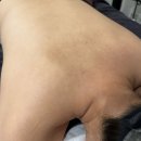 더록시에스테틱청담점 등트러블 강남피부관리 등강필 후기