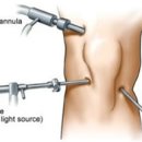 [관절내시경] 관절내시경으로 연골판 파열 어떻게 치료할까? 이미지