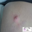 김성호피부과의원 | 지방종/표피낭종 제거는 미사 위대항병원에서..