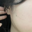 네이처피부과의원 | 건대 피부과 에스준 의원에서 점 빼기