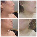 송탄 피부관리 "김현주 스킨케어" 20년 베테랑의 비행기 기법 얼굴축소 솔직 후기✨