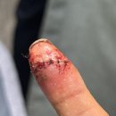 이안정형외과의원 | 칼베임 상처 6바늘 꿰맴 실비 청구 방법 및 보상 후기/🤕/현대해상 2세대 실손의료보험 필수서류/상해...