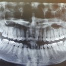 이백호치과의원 | 사랑니 발치 후기🦷