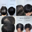 잠실 가르마탈모 두피페인팅 후기좋은곳 (+가격까지 합리적인곳)