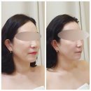성남대로171번길 | 분당 입체 윤곽 관리 추천 얼굴축소 리프팅 미금역 에르모소쌀롯 솔직후기