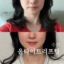 닥터바이오덤수원 | 수원 올타이트리프팅 잘하는 곳 내돈내산 후기 윤곽 관리